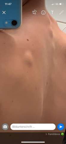 Demnach seien bei mehreren geimpften personen komplikationen durch blutgerinnsel aufgetreten, teilte die gesundheitsbehörde des landes mit. Knubbel unter der Haut an Rücken? (Gesundheit, Gesundheit ...