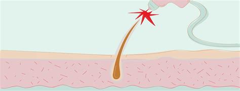 Because a laser is burning portions of the treated hair. Can You Get Laser Hair Removal with Psoriasis?