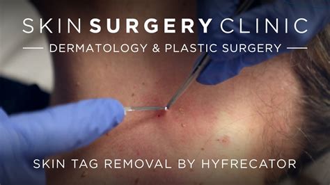 Skin Tag Removal By Hyfrecator Watch The Procedure Youtube