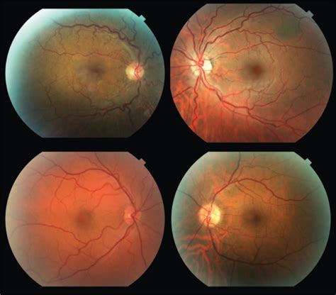 Representative Fundus Photographs From Patients With Osa Demonstrating