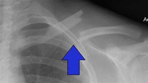 Broken Collarbone Or Clavicle Fracture Signs Symptoms And