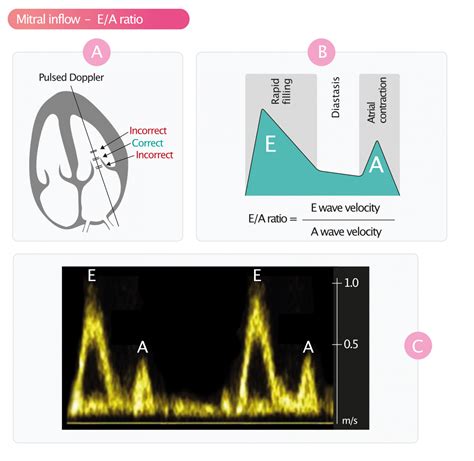 Assessment Of Diastolic Function By Echocardiography Ecg Echo