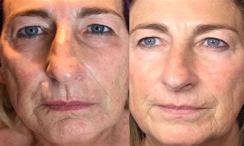 Introducing Plasma Lift Non Surgical Anti Ageing And Skin Rejuvenation