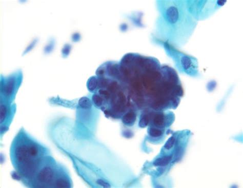 Atypical Glandular Cells On A Pap Smear Of The Cervix Mypathologyreportca