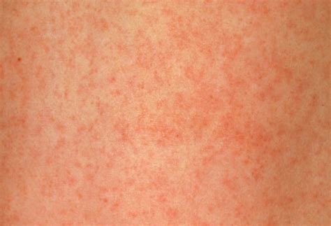 German Measles Pictures Symptoms Causes Treatment