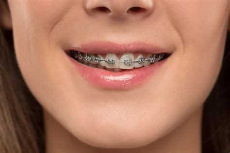 ¿qué Tipos De Brackets Existen En Ortodoncia Dentista Usera