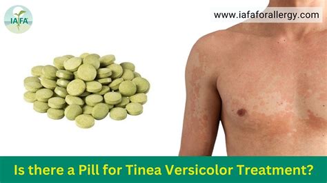 Is There A Pill For Tinea Versicolor Treatment