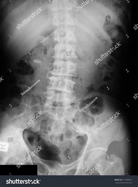 X Ray Image Plain Kub Kidney Stock Photo 271398215 Shutterstock