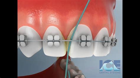 Meanwhile, below are some flossing techniques that can make the whole experience with braces an. Flossing With Braces - YouTube