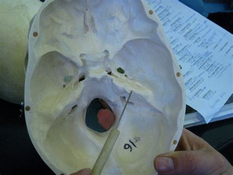 Boned Human Skull Petrous Part Of Temporal Bone