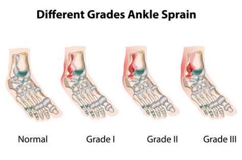 All About Sprained Ankles Umina Podiatry