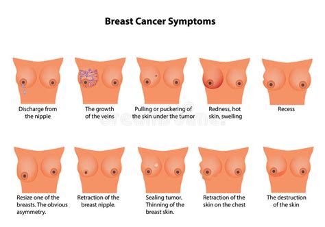 Some other signs and symptoms of breast cancer you should know, are: Symptoms Of Breast Cancer. Infographics. Vector ...