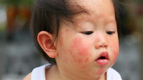 湿疹诊断 湿疹诊断标准 湿疹诊断流程 复禾疾病