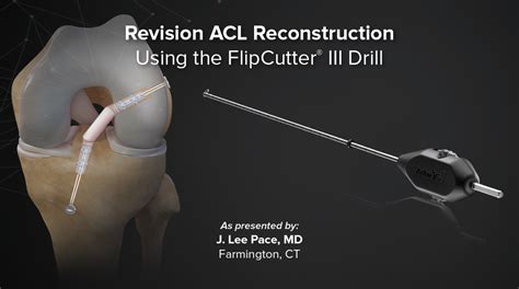 Arthrex Revision Acl Reconstruction Using The Flipcutter® Iii Drill