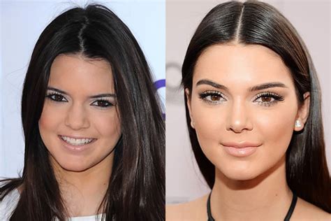 Before and after with images. Kendall Jenner, Lip Injections & Plastic Surgery?