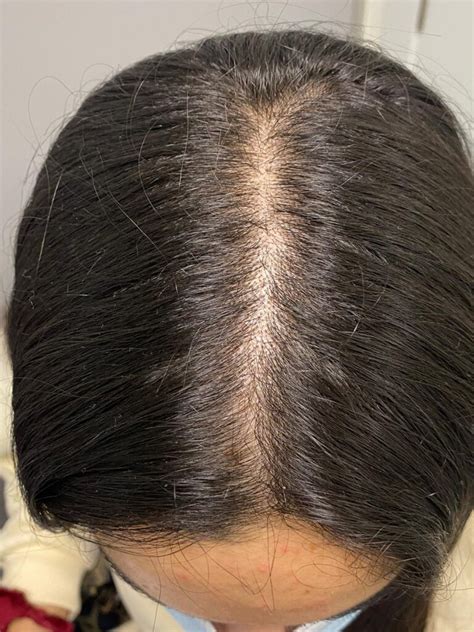 Alopecia Androgénica Femenina Estoy Clareando