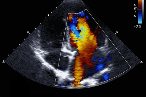 Having An Echocardiogram What You Need To Know Upmc Healthbeat