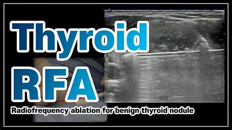 Radiofrequency Ablation For Benign Thyroid Nodule Youtube