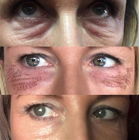 Under Eye Laser Skin Tightening Before And After Osmonroegner 99