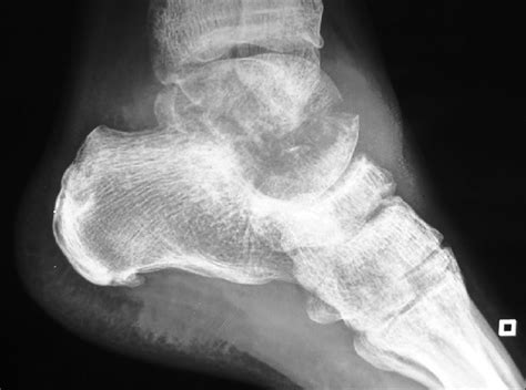 X Ray Left Foot And Ankle Image Showing Lytic Lesion In The Talus With