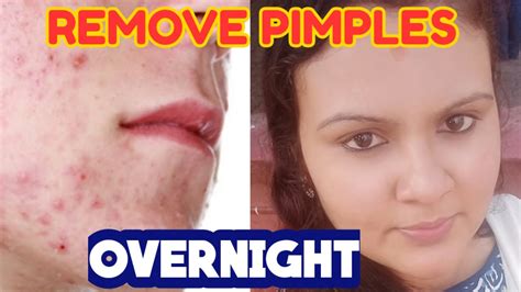 How To Get Rid Of A Pimple In One Dayhomemade Pimple And Acne Treatment