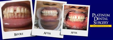 Platinum Dental Surgery Award Winning Dentist In Lagos Nigeria