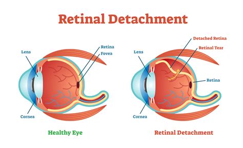 Surgery For Retinal Detachment Nader Moinfar Md Mph Facs Fasrs