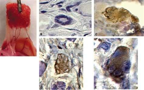 Etiology Pathogenesis And Treatment Of Radiation Induced Xerostomia