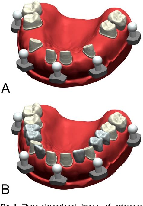 Figure 1 From In Vitro Accuracy Of Complete Arch Scans Of The Fully
