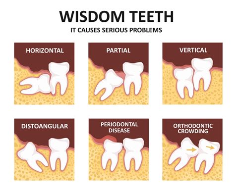8 Warning Signs For Impacted Wisdom Teeth And 4 Impaction Type