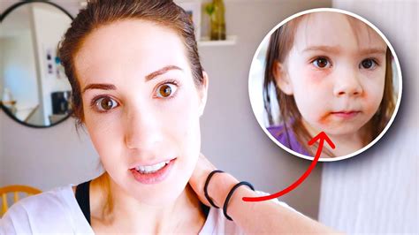 Allergic Reaction Burned Our Toddler's Skin?! 