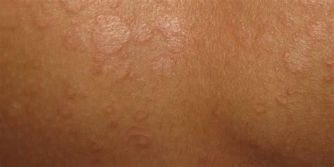 Tinea Versicolor Pictures Symptoms Causes Treatment