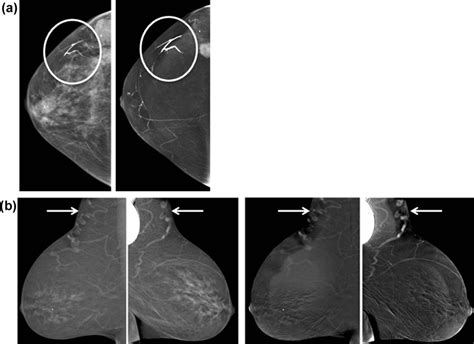 Contrast Enhanced Spectral Mammography Academic Radiology