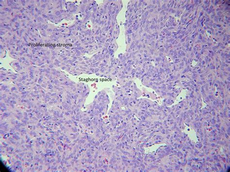 Moran Core Orbit Histopathology