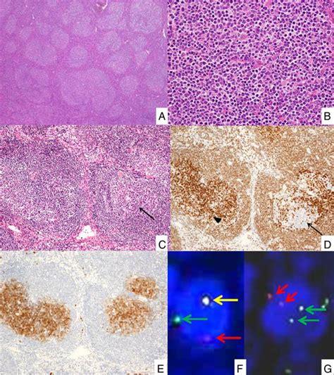 Case 2 A And B Follicular Lymphoma Fl Developed In The Cervical