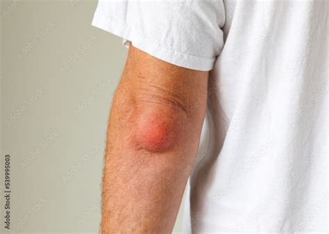 Man Swelling Erythematous Lump Pain Elbow From Olecranon Bursitis