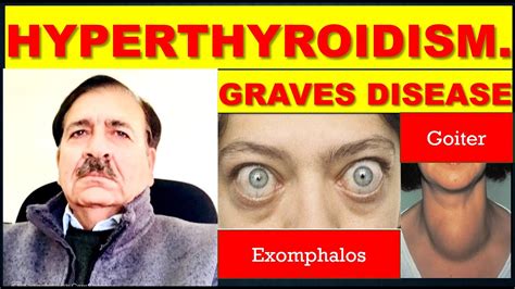 Graves Disease Hyperthyroidism Causes Symptoms Diagnosis And