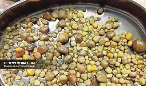 Kemudian, pembedahan kecil diperlukan untuk. 420 Biji Batu Karang Dalam Buah Pinggang | The Hyper Media