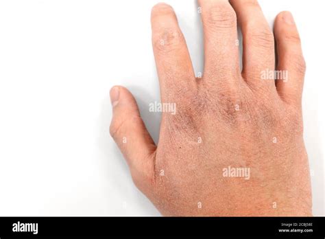 Cracked Skin Hi Res Stock Photography And Images Alamy