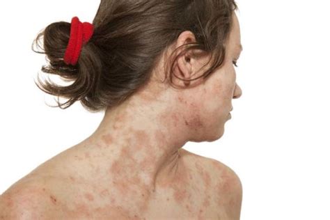 Eczema O Que Tipos Causas Sintomas Preven O Tratamentos