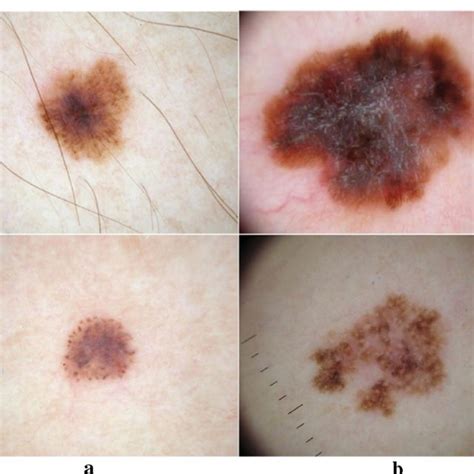 A Few Examples Of Pigmented Skin Lesions A Benign Lesion B Malignant