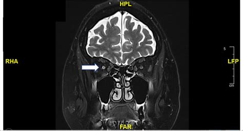 Frontiers Pembrolizumab Induced Optic Neuropathy A Case Report