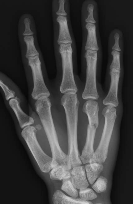 Finger Fracture Treatment Raleigh Hand Surgeon
