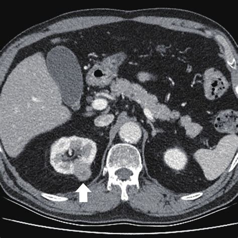 An Abdominal Computed Tomography Scan Reveals The Right Renal Mass The