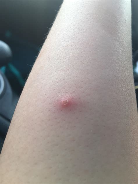 Does This Look Like A Spider Bite Itchy And Showed Up 2 Days Ago On My