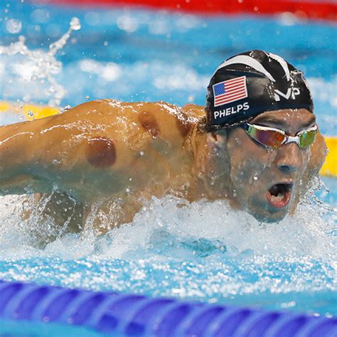 Michael Phelps And Cupping All About This Therapy My Vanderbilt Health