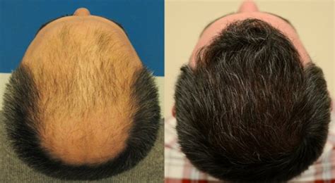 Corticosteroids are used to treat some forms of hair loss, however, so the main connection between. Corticosteroid, Betamethasone and Hair Loss | HairSite.com