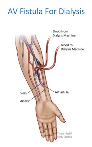 Check spelling or type a new query. AV Fistula Surgery for Dialysis in Tampa FL - Expert ...
