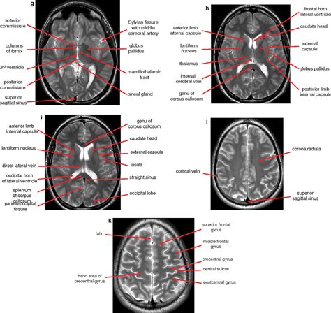 Normal Anatomy Of The Brain On Ct And Mri With A Few Normal Variants