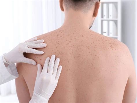 Cancer De Pele Sintomas Coça